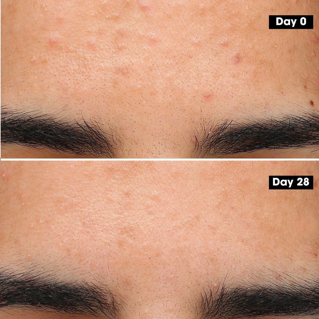 Sephora Acne Treatment Gel